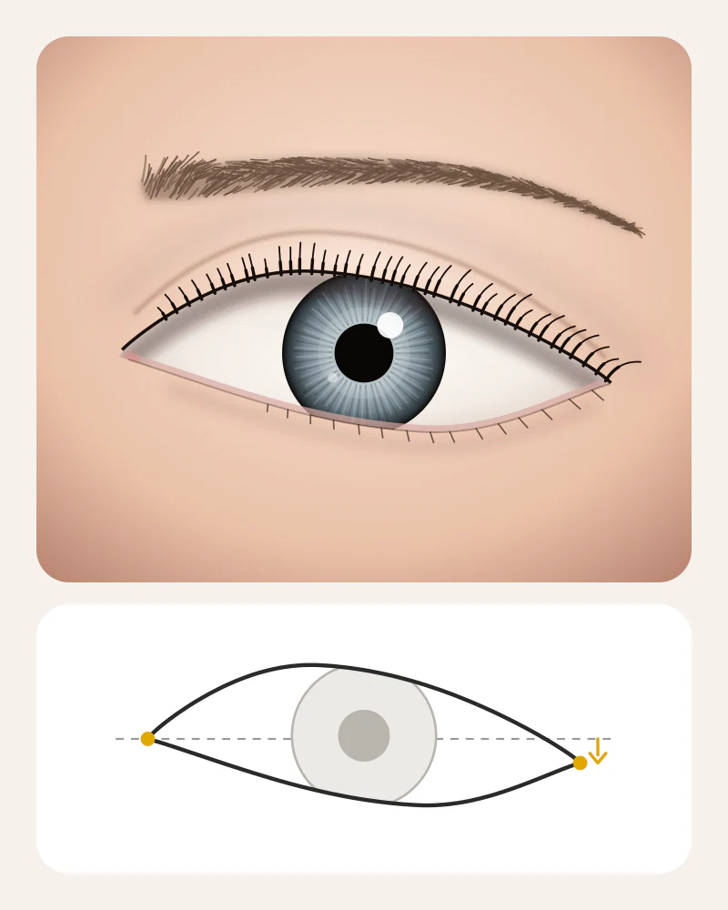 Illustration of downturned eyes: the outer corner sits lower than the inner corner