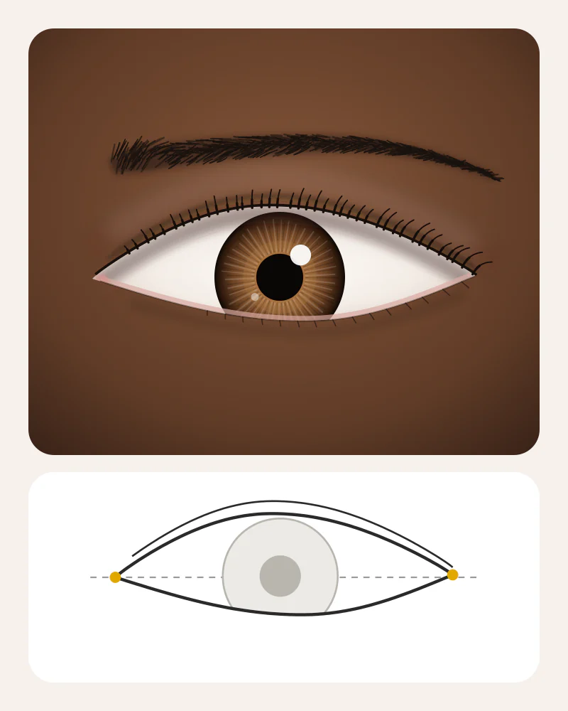 Illustration of hooded eyes: a fold of skin from the brow bone covers the eyelid down to the lash line