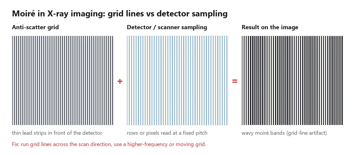 Moire effect in X-ray radiography: anti-scatter grid lines plus detector sampling produce a moire pattern