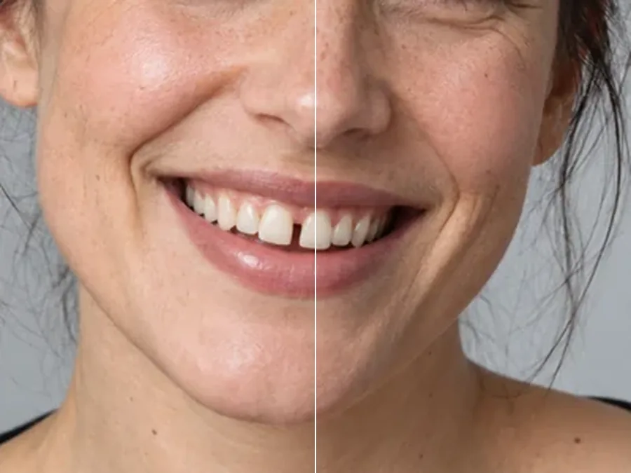 Close-up smile split in half: uneven yellow teeth on the left, aligned white teeth on the right